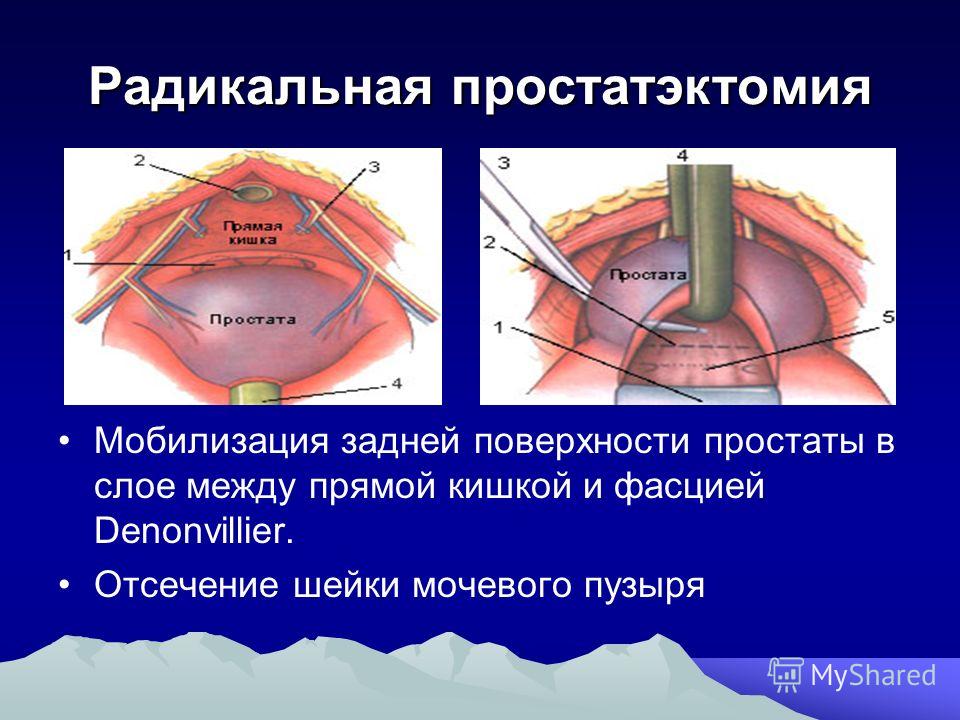 После удаления простаты